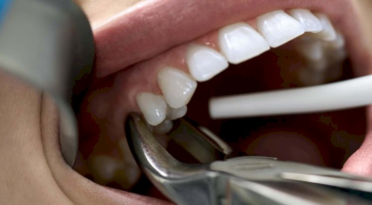 Are Tooth Extractions Cheaper Than Root Canals?