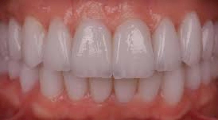 Does Full Mouth Rehabilitation Involve Orthodontics?