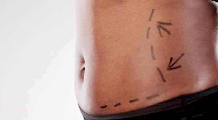 Liposuction Cost in Pakistan: Breaking Down Prices, Factors, and Real Patient Insights