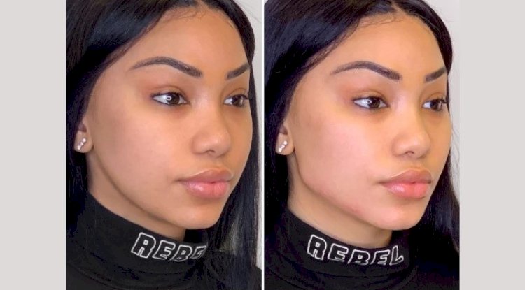 Enhance Confidence Through Affordable Thread Lift Treatments in Dubai Options