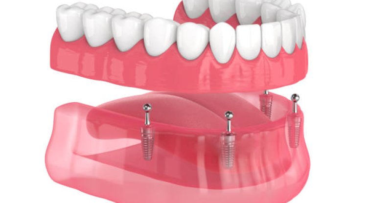 How to Choose the Right Dentures for Your Needs 