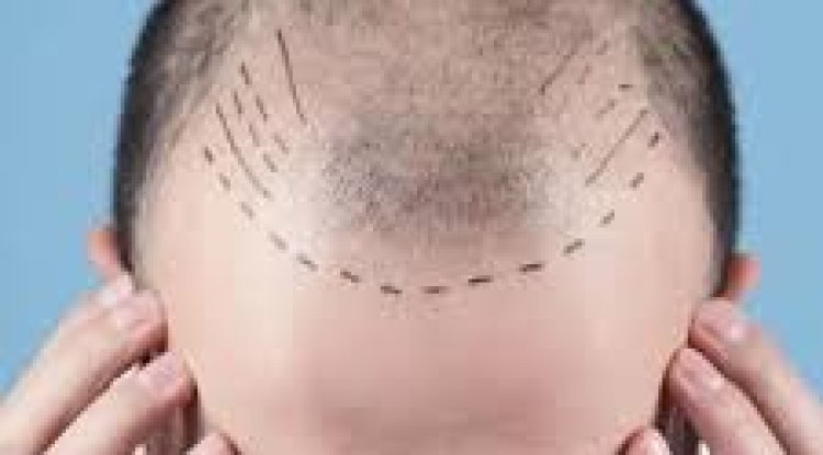 دليلك الشامل حول زراعة الشعر في الرياض: التقنيات، التكلفة، والنتائج المتوقعة