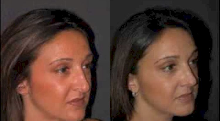 Revision Rhinoplasty in Riyadh: How to Fix a Previous Surgery