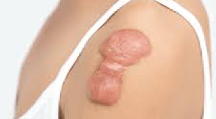 Non-Invasive Solutions for Keloid Scars