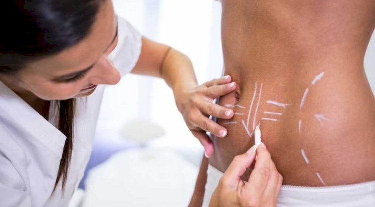Body Contouring in Islamabad: What Locals Are Saying