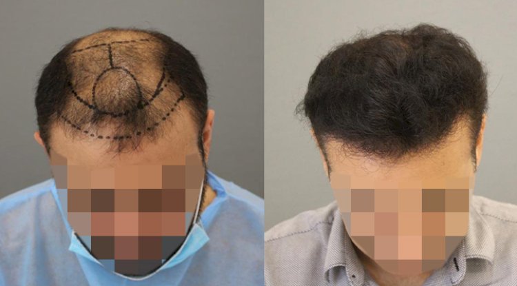 زراعة الشعر في دبي: حيث تلتقي الرفاهية بالنتائج الطبيعية المذهلة