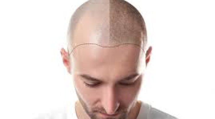 Affordable Hair Transplant in Islamabad’s F-7 and F-10 Areas