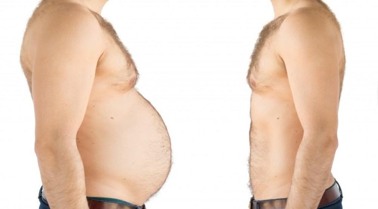 Bariatric Surgery Myths vs. Facts in Islamabad
