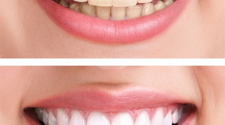 Fast Teeth Whitening Solutions in Islamabad