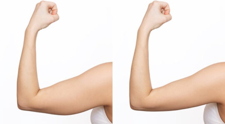 Why "Ozempic Body" Patients are Flocking to Arm Lift Surgery in Riyadh