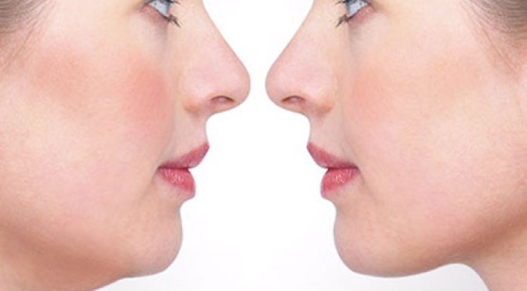 Injectable Treatments for Double Chin Reduction in Islamabad