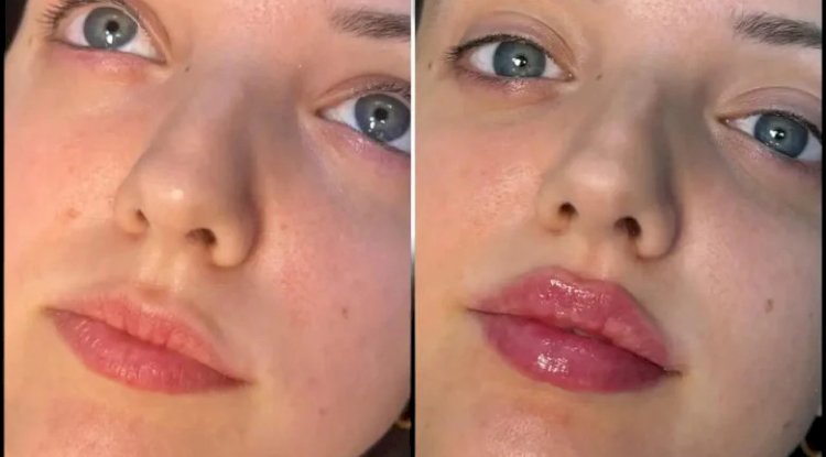 Best Plastic Surgeons in Dubai for Personalized Filler Solutions
