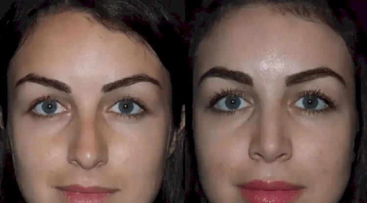Best Rhinoplasty Surgeon in Dubai for Advanced Rhinoplasty Care