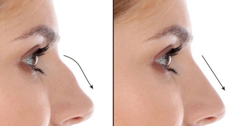 Best Septoplasty Surgeons in Dubai for Evidence-Based Correction