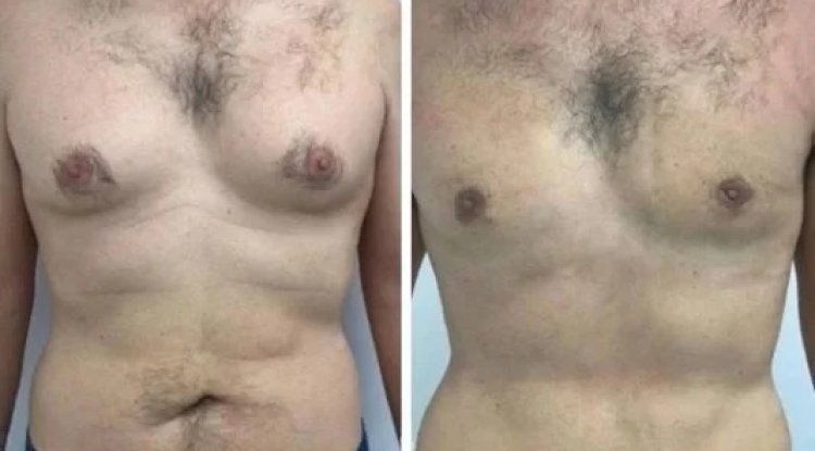 Best Gynecomastia Surgeons in dubai: A Safe and Effective Choice
