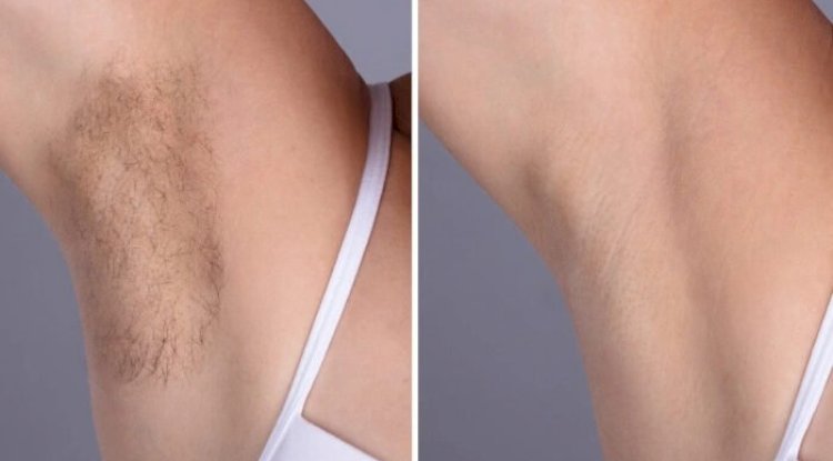 Electrolysis Laser hair removal treatments in dubai: Say Goodbye to Shaving