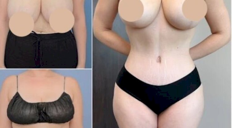 Best Doctors in Dubai for Tummy Tuck and Safe Fat Removal