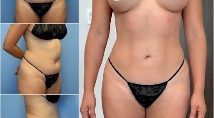 Best Doctors in Dubai for Body Contouring and Body Reshaping Excellence
