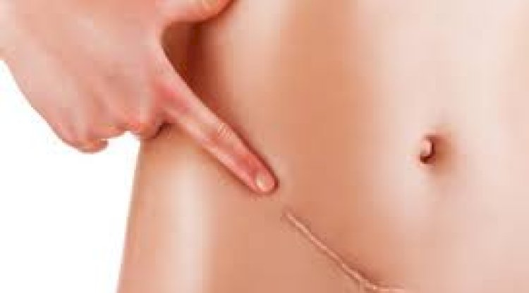 Steroid Injections for Keloids in Islamabad: What You Need to Know