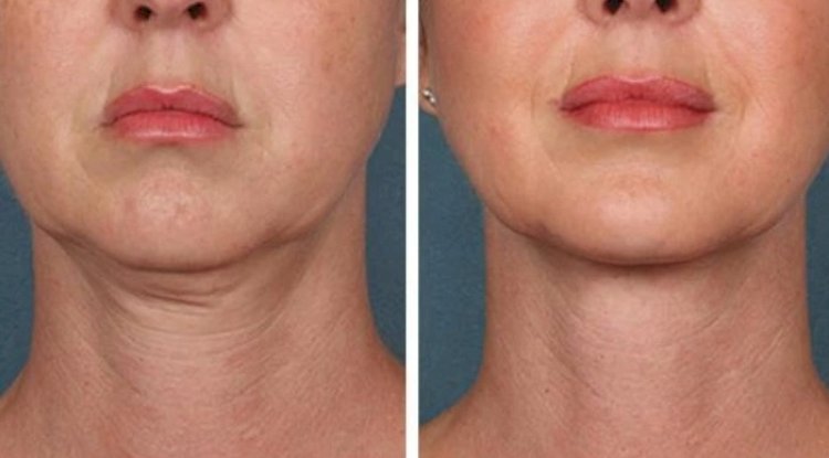 Best Doctors in Dubai Leading PRP Treatment Excellence