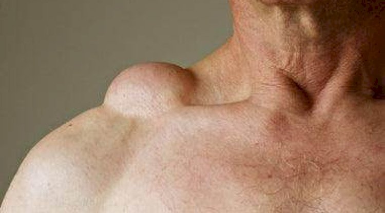 Lipoma Surgery in Islamabad’s Top Hospitals