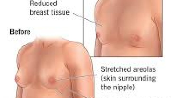Tips to Manage Gynecomastia Surgery Cost in Islamabad Without Compromising Safety