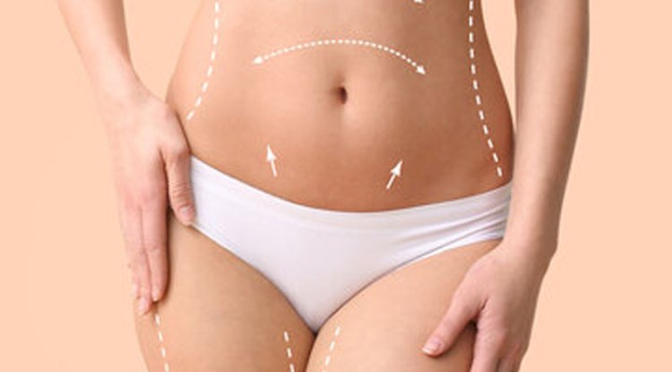 Liposuction for Different Body Types What Works Best?