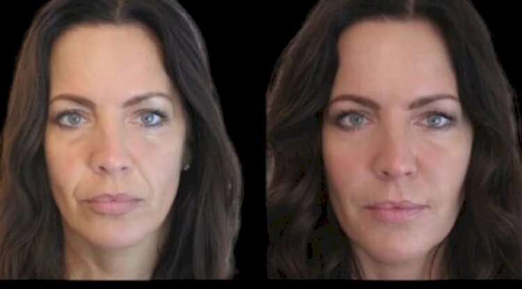 Best Plastic Surgeons in Dubai for Jawline Perfection with Jawline Fillers