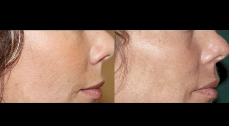 Collagen Renewal with Fractional RF Microneedling by the Best Plastic Surgeons in Dubai