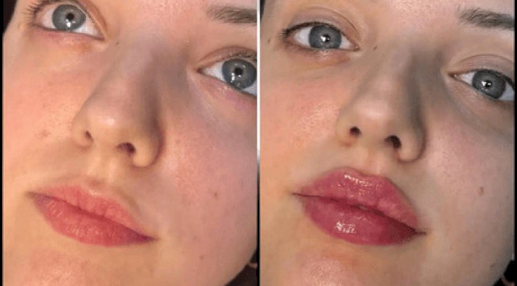 Best Aesthetic Clinics in dubai for Fillers Expert Touch for Flawless Skin