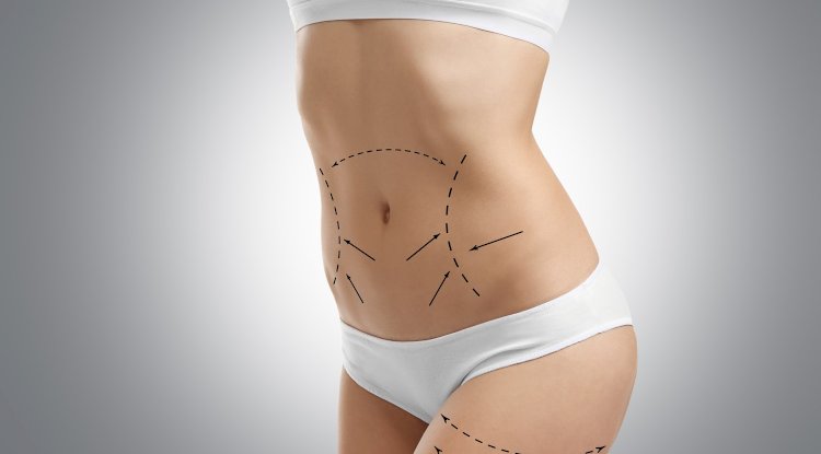 Are You an Ideal Candidate for Transformative Liposuction Results?