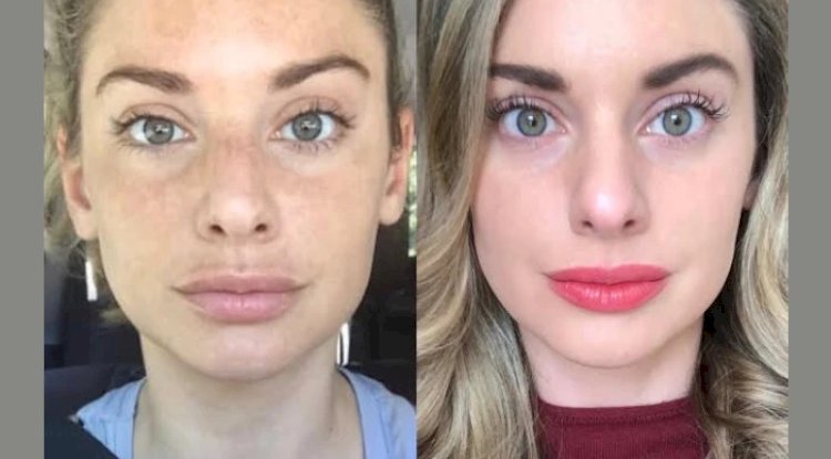 Visible Results with Radiofrequency (RF) Microneedling by the Best Aesthetic Clinic in Dubai