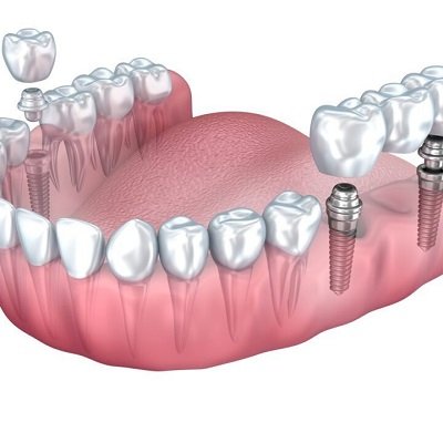 Common Misconceptions About Dental Implants
