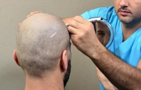 Hair Transplant in Dubai – Restore Hair. Reclaim Confidence.