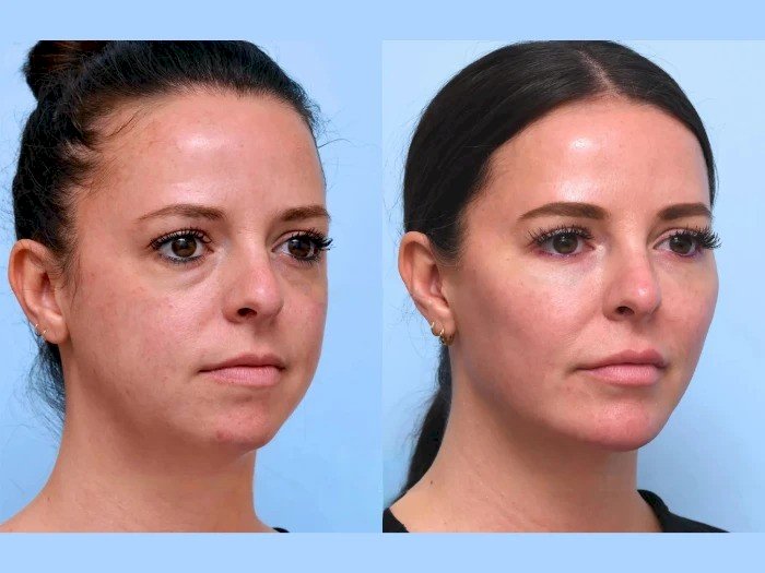 How to Find the Best Doctors in Dubai for a Non-Surgical Thread Lift