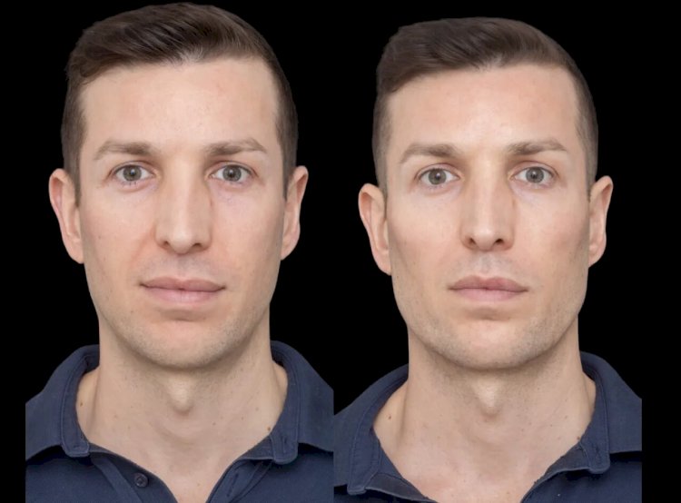 The Best Aesthetic Clinic in Dubai: Home to Top Cheek Filler Experts