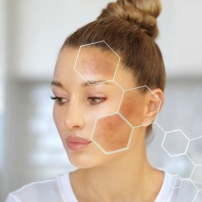 Pros and Cons of Natural vs Medical Melasma Treatments in Islamabad