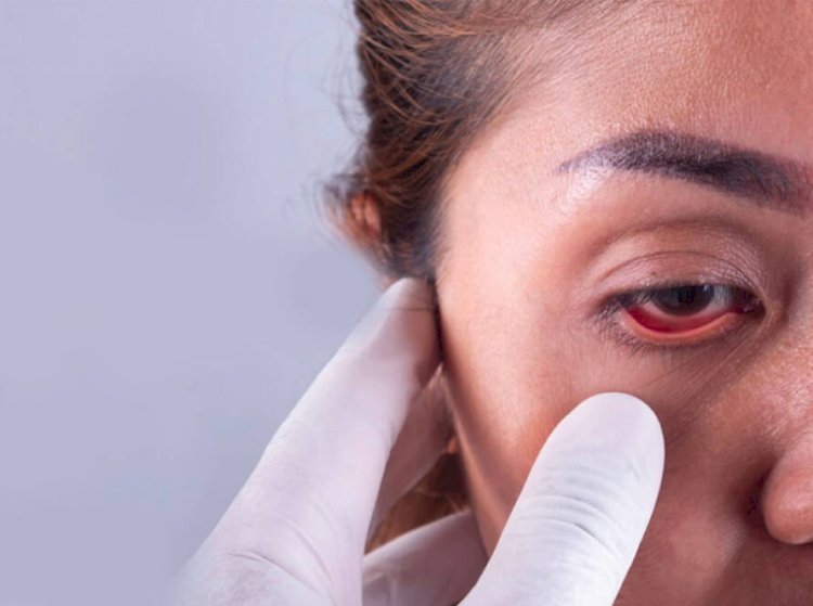 Natural Ayurvedic Solutions for Managing Glaucoma Without Surgery