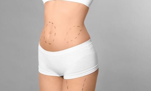 Under the Knife, Over the Top: Liposuction in the Limelight