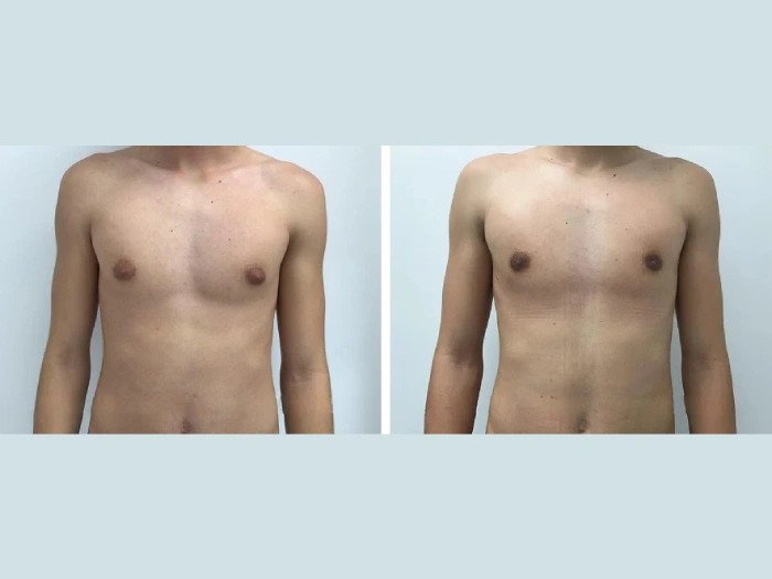 Gynecomastia in Dubai: What to Expect Before and After