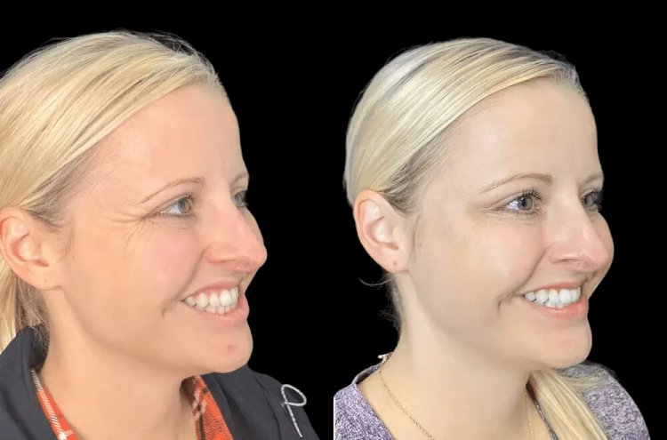 Natural-Looking Botox Results: Tips from the Best Doctors in dubai