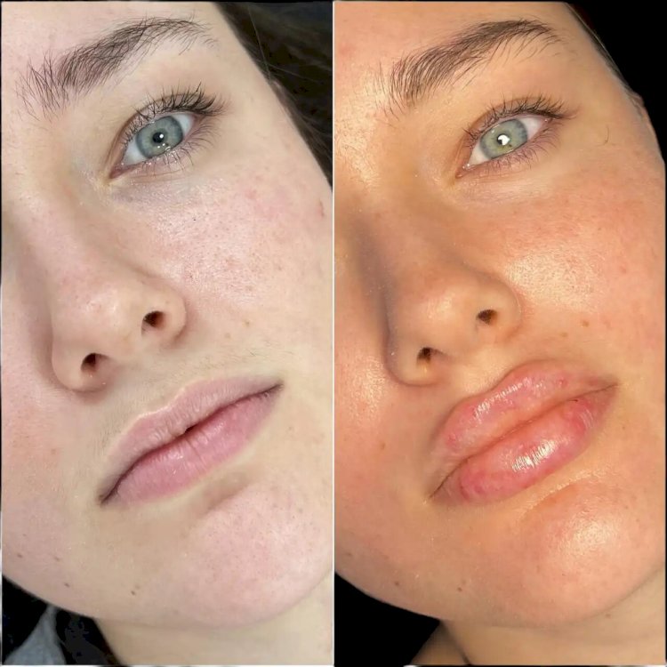 Fillers in Dubai: Restore Volume and Youthful Contours