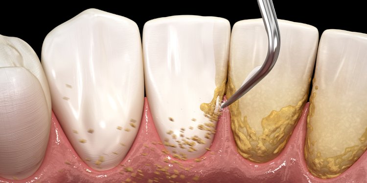 Scaling of Teeth What It Is, Why It’s Important, and How It Improves Your Oral Health
