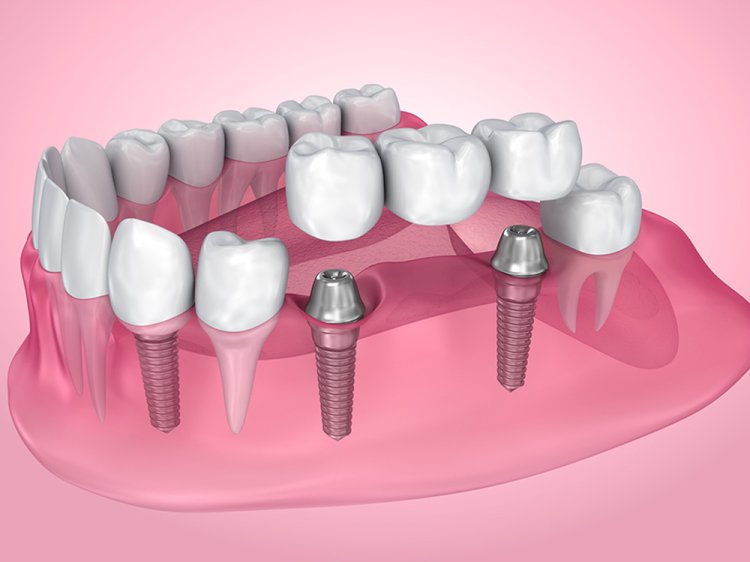 Reclaim Your Confident Smile with Dental Bridges in York: What You Need to Know