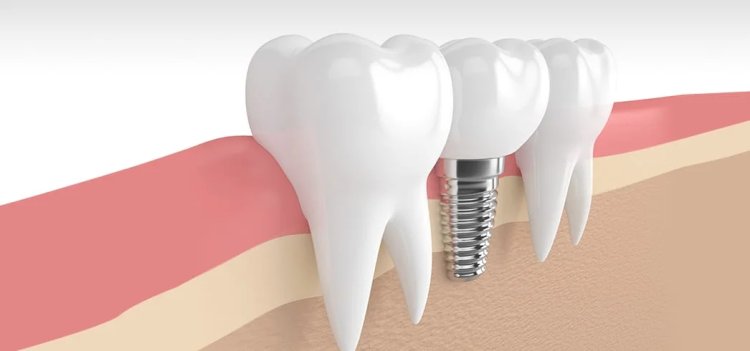 Sparkle with Every Smile Using Dental Implants in Dubai