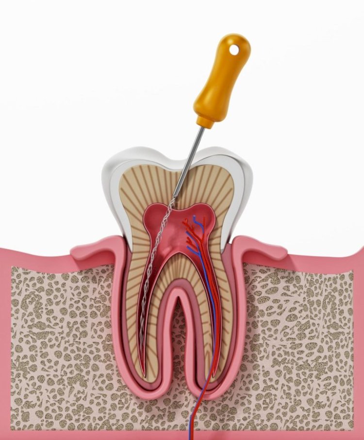 Root Canal Treatment Specialist Near Me: Expert Tooth Care at Dr. Neetu’s Multi Speciality Dental Clinic, Panchkula