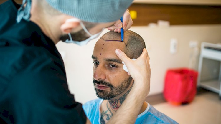 How Hair Transplants Have Evolved Over the Last Decade