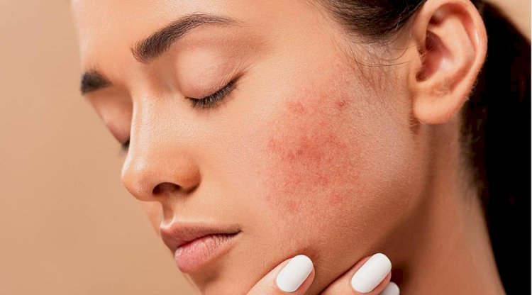 Discover the Best Homeopathy Treatment for Acne in Dubai: A Natural Path to Clear Skin