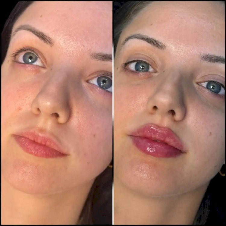 Fillers Treatments in Dubai: Making Your Jawline the Star of Your Face