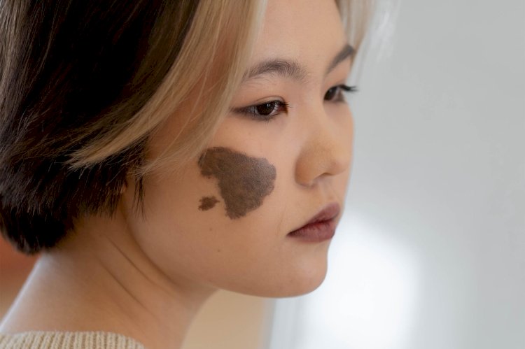 How Does Laser Birthmark Removal Work?
